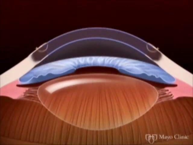 Cornea transplant