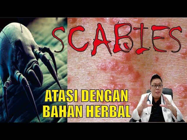 SCABIES..................... ATASI DENGAN MENGGUNAKAN BAHAN HERBAL