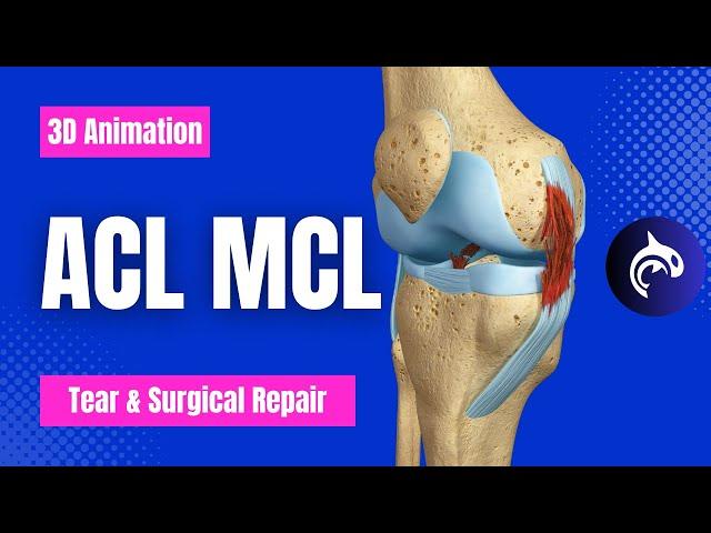 ACL and MCL Tear and Surgical Repair - 3D Animation