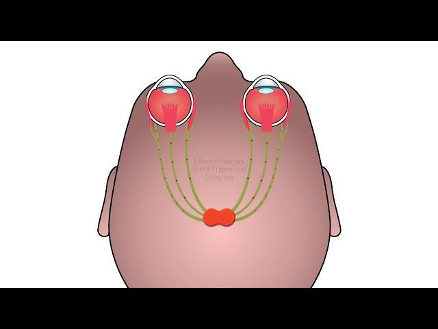 Trigeminal Dysphoria 1min
