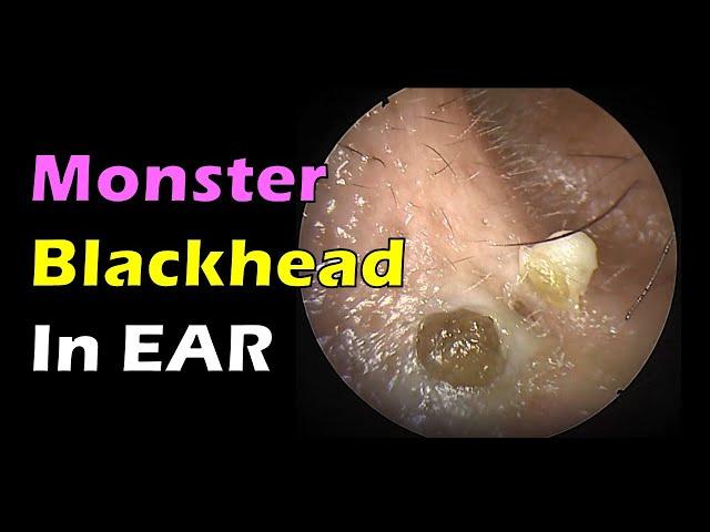 Monster Blackhead in Ear