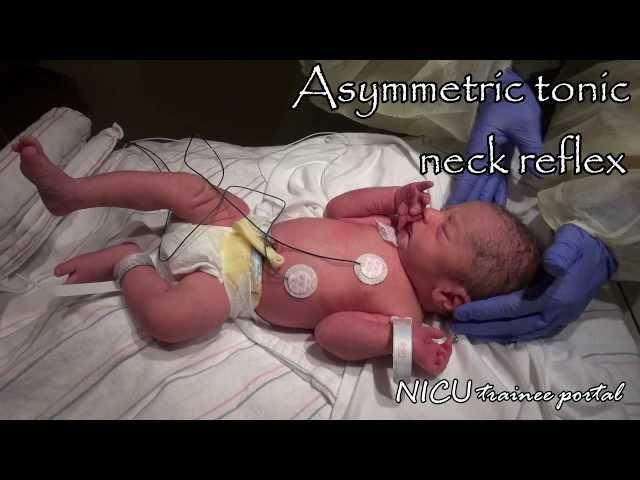 Physical Exam- 35 weeks gestation late preterm infant