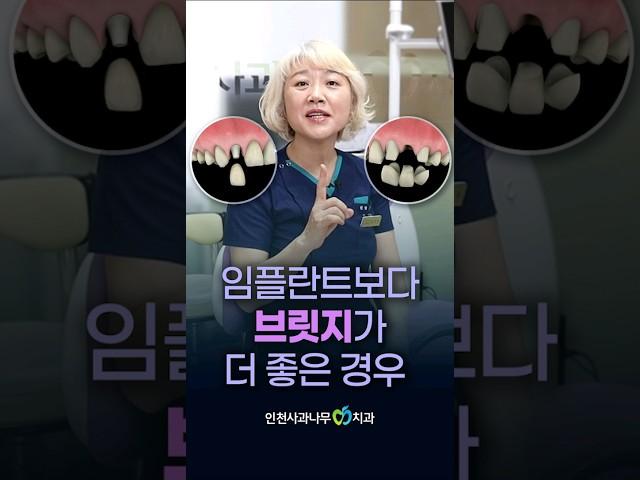 임플란트보다 브릿지가 더 좋은 경우