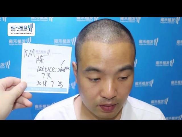 【植髮日記】#M型禿 的他來到了雍禾植髮│術后12個月成果│Yonghe hair transplant