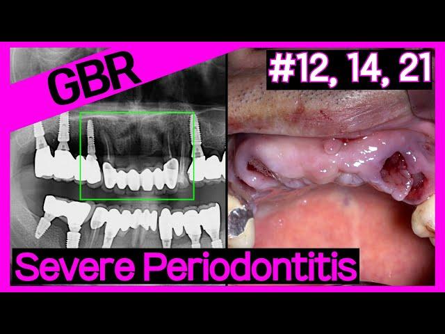 [Online Surgery] Implant therapy after socket preservation for maxillary anterior teeth