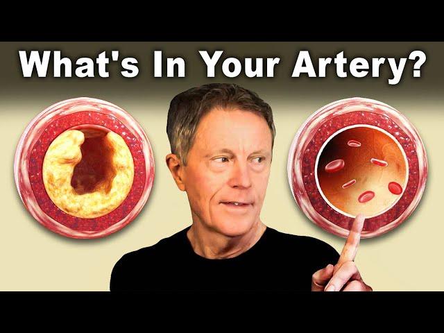 #1 Best AT HOME Test to Find Clogged Arteries