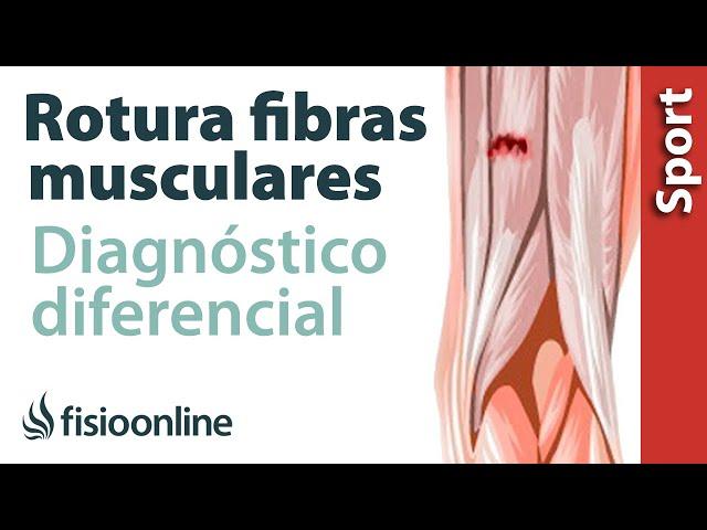 ¿Cómo diferenciar si tienes una rotura de fibras o una contractura o espasmo muscular?