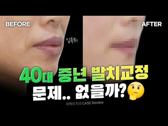 40대 중년 치아교정 돌출입교정 변화가 있을까 (feat.발치교정)