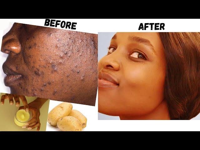 Remove Dark Spots In 10 Days with Potato Cream  | How To Get Rid Of Pimples and Acne