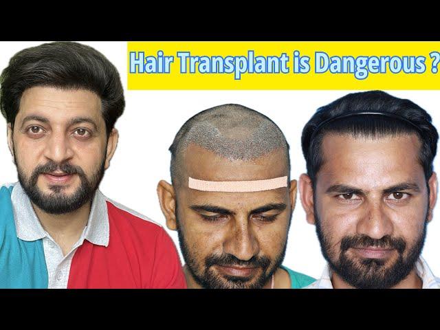 Natural looking Hair Transplant results | Hair Transplant Cost In India| Interlocking FUE technique