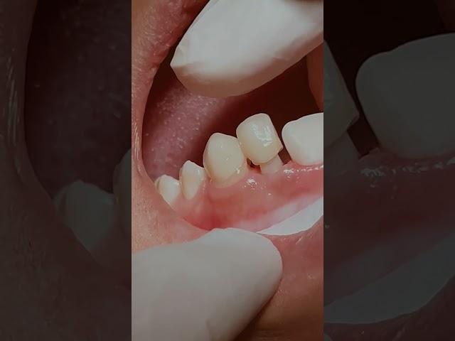 Zirconia crowns #dentistry