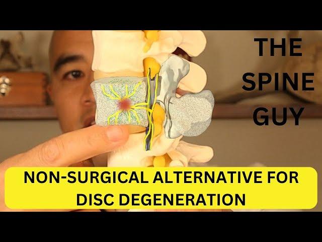 What is Basivertebral Nerve Ablation? A non-surgical alternative for Degenerative Disc Disease