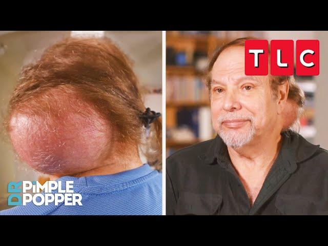 This Man Has a Softball-Sized Bump on His Neck! | Dr. Pimple Popper | TLC