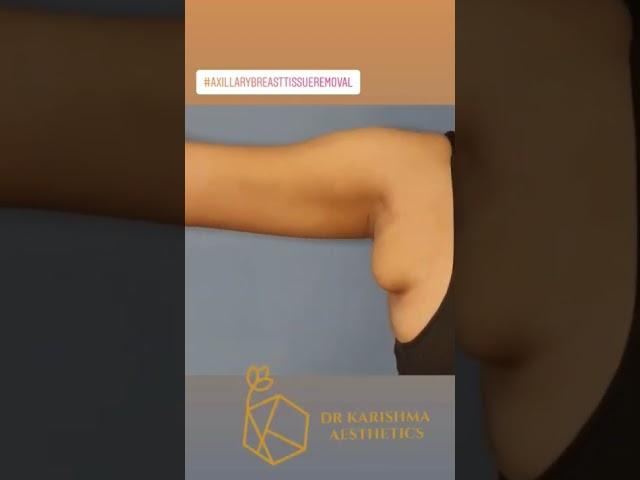 Single Keyhole Incision Armpit Tissue Removal #axillarybreastisuueremoval #shorts