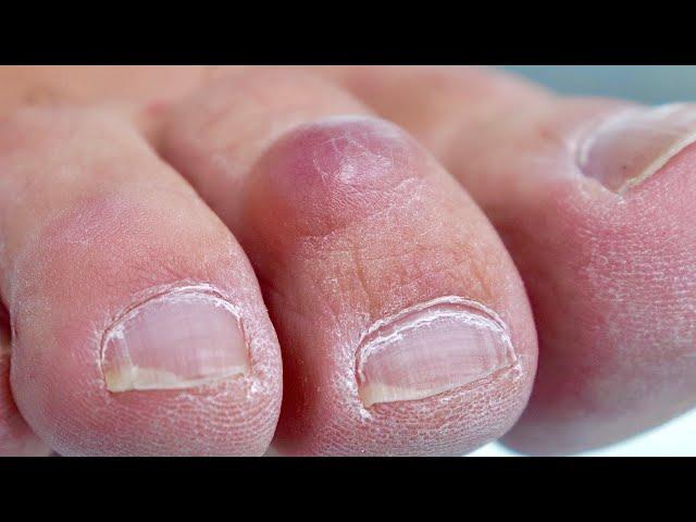 Toe CYST Being SQUISHED & POPPED 