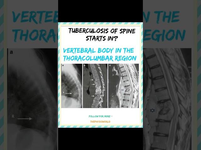 TUBERCULOSIS OF SPINE Follow @thephysiooworld9274 for more #physiotherapy #physio #bpt