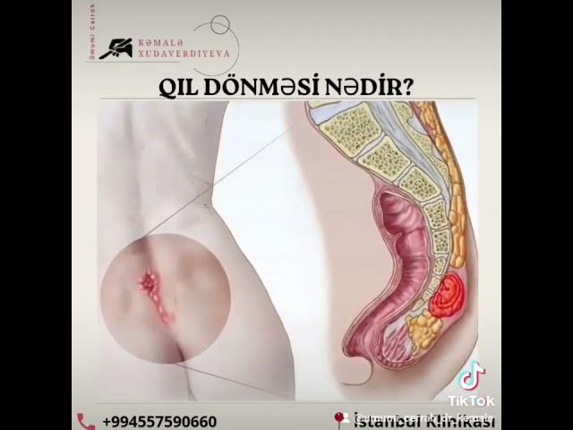 Ümumi Cərrah Dr Kəmalə Xudaverdiyeva İstanbul Klinikası +994557590660