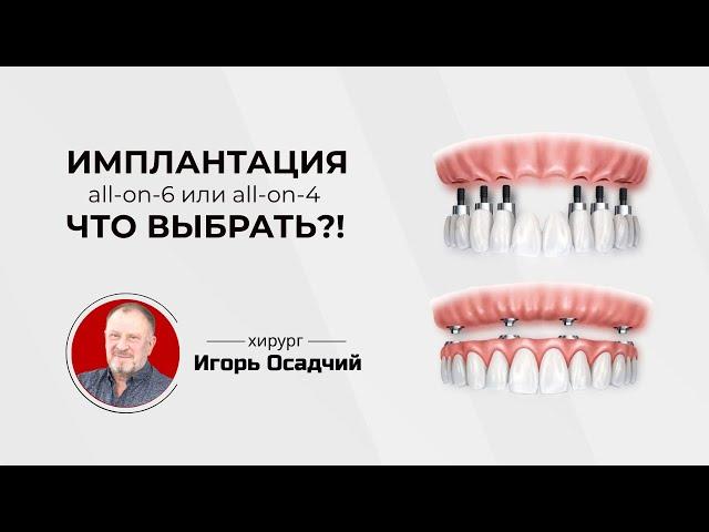 Имплантация Все-на-4 и Все-на-6, что выбрать?