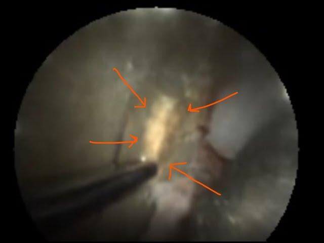 Calculus removal using Oravu Fiberscope