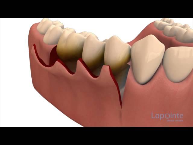 Periodontal flap approach surgery - Lapointe dental centres