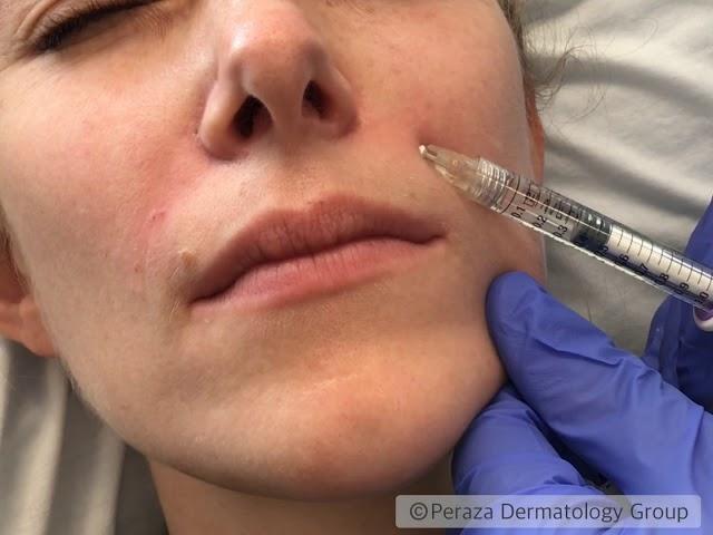 Juvéderm® Nasolabial Folds Demonstration