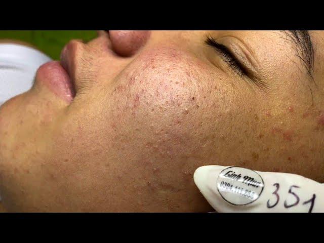 The best acne squeezing collection form Linh Mun Spa part 9