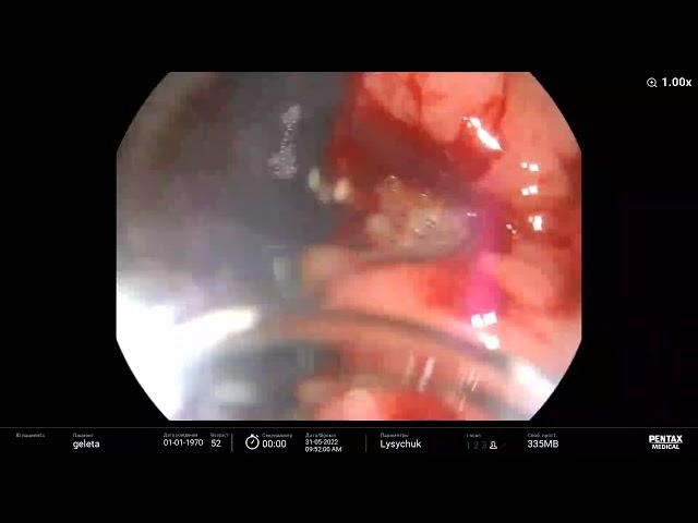 Stomach carcinoma/ Низкодиф.аденокарцинома желудка