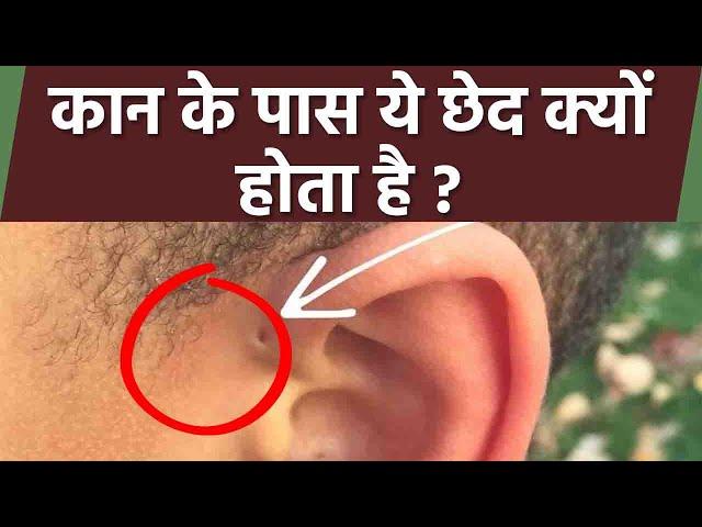 कान के ऊपर छेद होना Preauricular Pit, Preauricular Ear Hole क्या है | Boldsky *Health