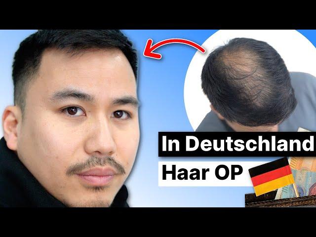 Meine Haartransplantation in Deutschland | Erfahrung nach 7 Monaten