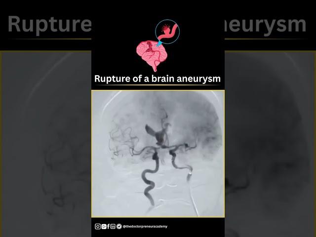 What Happens When a Brain Aneurysm Bursts? 