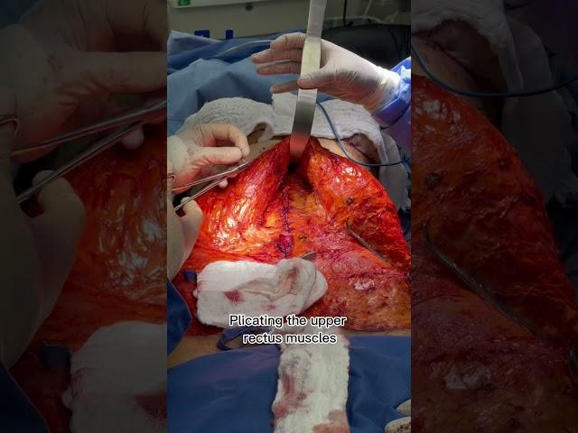 Diastasis Repair during Tummy Tuck by Dr. Erick Sanchez
