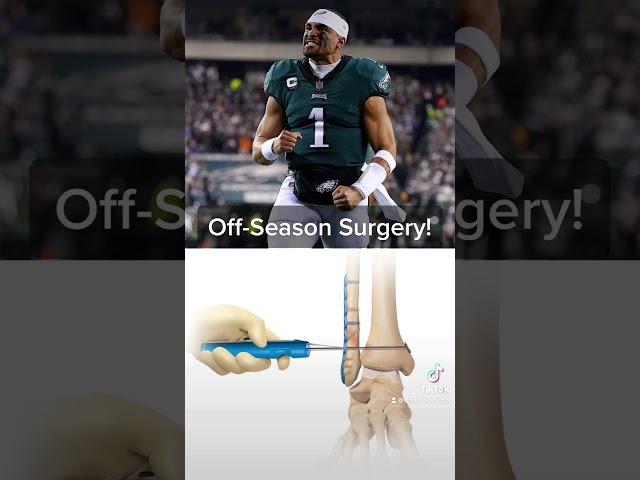 Jalen Hurts off-season ankle surgery. Expert explains | #jalenhurts #philadelphiaeagles #nfl