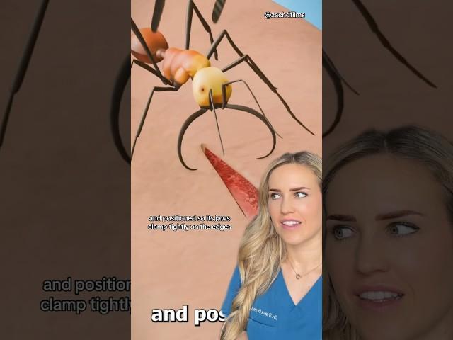 Doctor reacts: ant stitches?! @zackdfilms