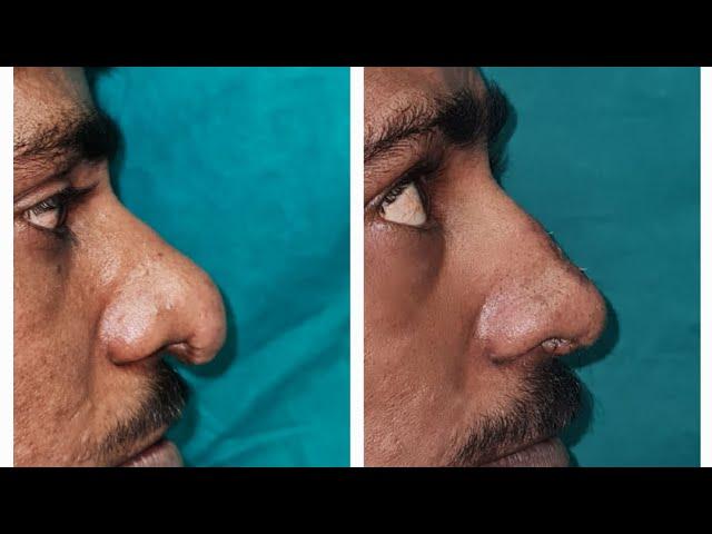 nasal tip plasty.smas reduction dr jalil mujawar