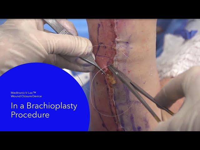 The V-Loc™ Wound Closure Device in a brachioplasty procedure