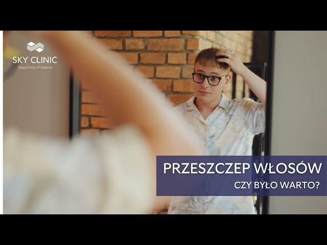 Dlaczego Zdecydowałem się na Przeszczep Włosów? Historia pacjenta Sky Clinic