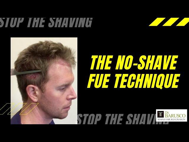 Stop the Shaving!! "No-Shave" FUE Hair Transplant