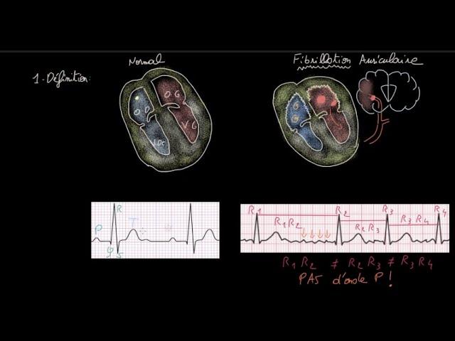 Fibrillation auriculaire - Définition - Impact - Evaluation - Anticoag / HH - FC / Rythme