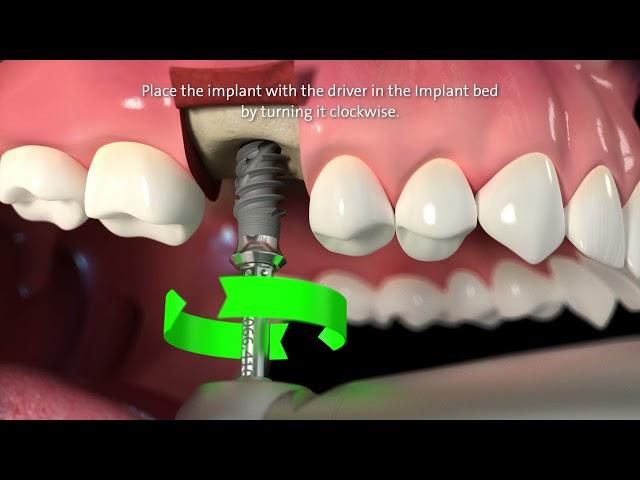 Straumann® TLX Implant System Step by Step