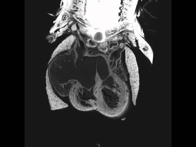 [51959]019-005-LD coronal.mov