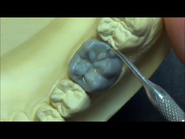 Live wax up - Lower 1st molar wax up (full)