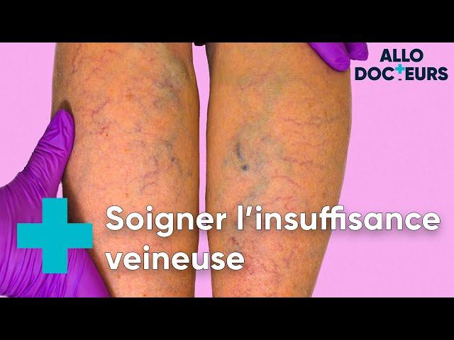 Jambes lourdes, varices... il existe des solutions - Allo Docteurs