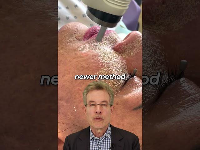 CO2 Laser Skin Resurfacing