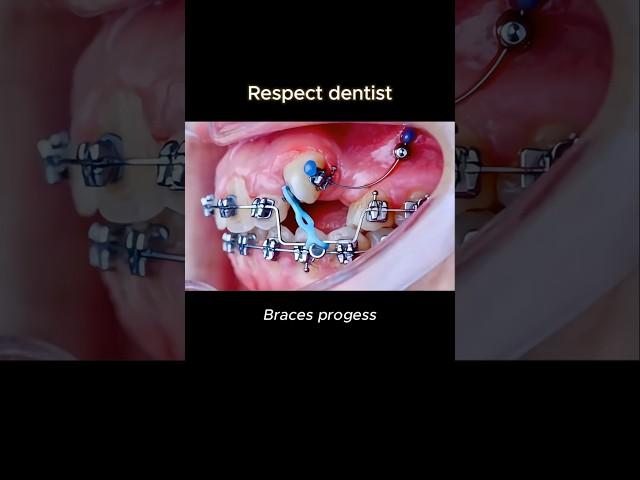 Braces as magic. Respect the dentist #braces #dentist #orthodontist