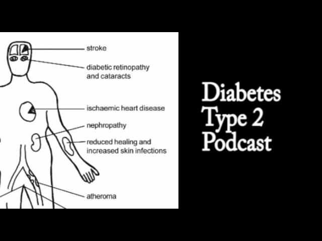 Diabetes, Type2