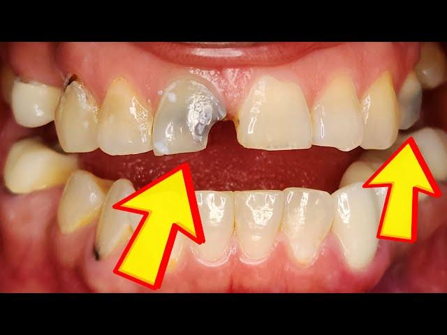 Dentist Explains Every Cause of Gray Teeth & Why Your Tooth is Turning Grey, Dark, & Possibly Dying!