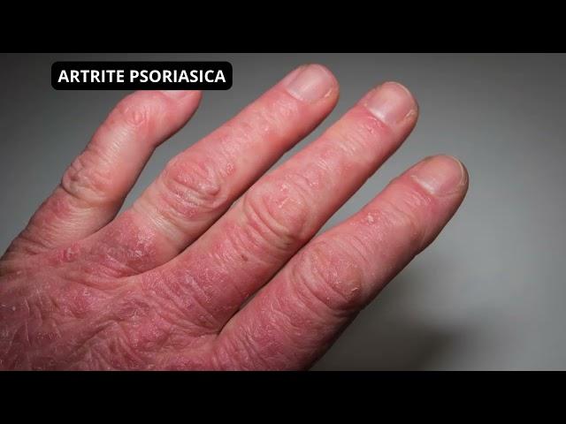 ARTRITE PSORIASICA