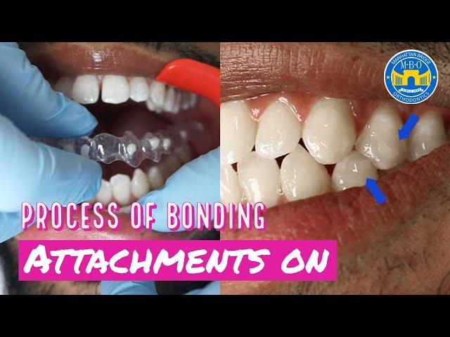 How Invisalign Attachments are placed?