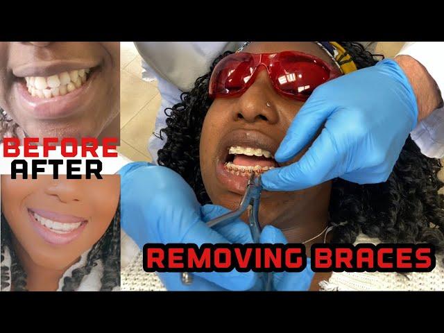 Braces Off after 25 months | Process of Removing Braces