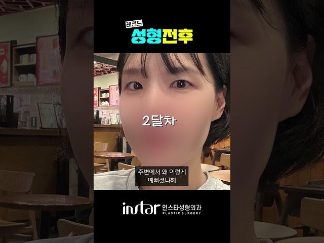 요즘 눈 성형 트렌드는 ? '무쌍눈매교정'  #성형외과 #강남성형외과 #무쌍눈매교정 #무쌍 #무쌍수술 #눈매교정 #눈매교정후기